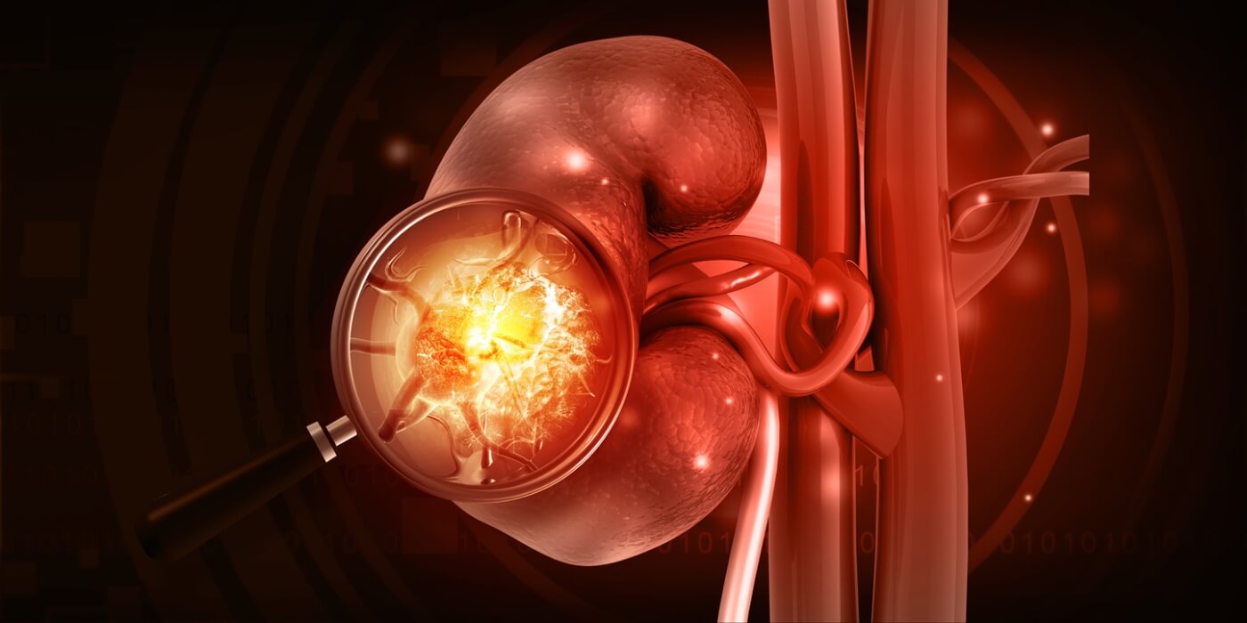 Postoperative Acute Kidney Injury